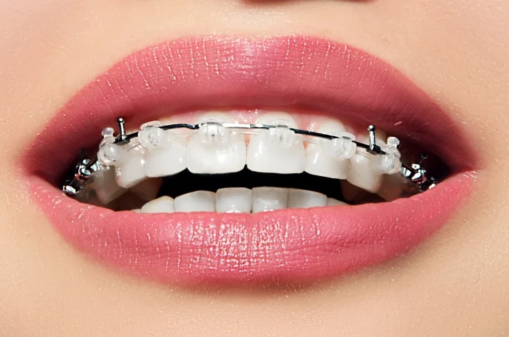 Metal Braces