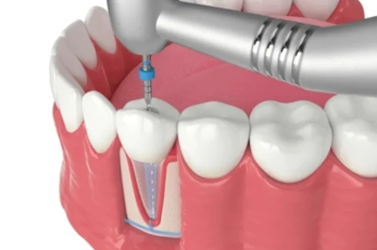Root Canal Treatment-----