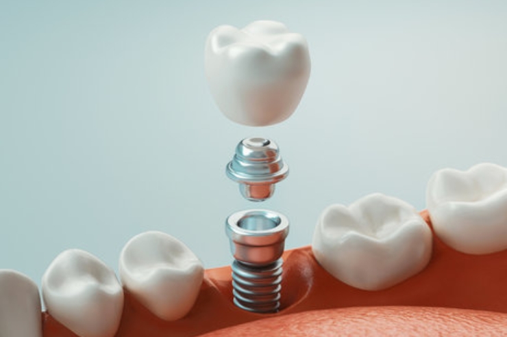 Single Tooth Implants