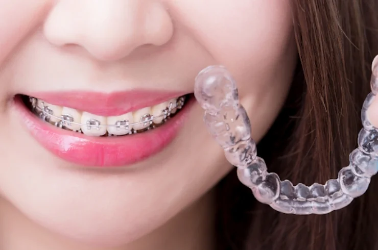 Clear Aligners